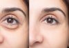 filler under eyes