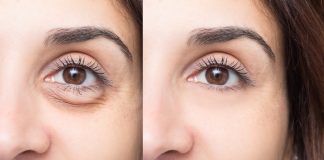 filler under eyes