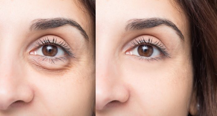 filler under eyes